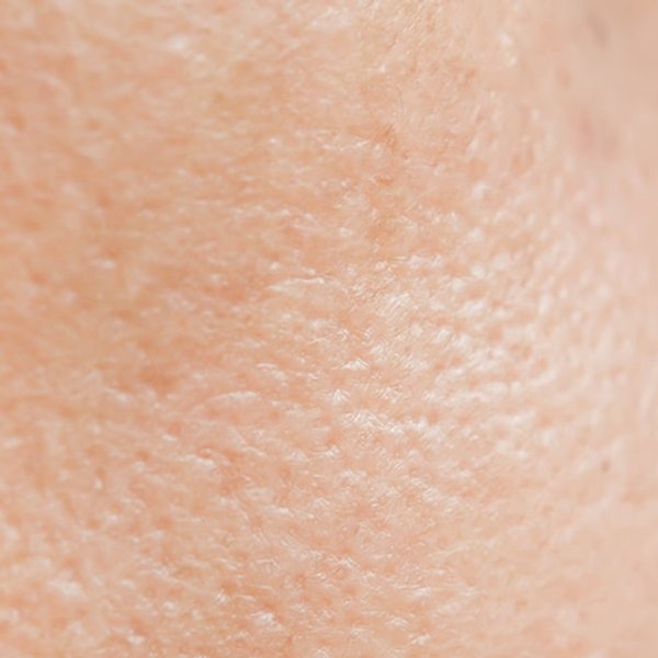 Članek o aknasti koži - glavna slika
